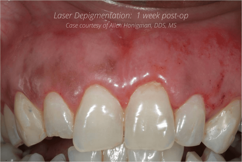 Laser Depigmentation Case – Allen Honigman – 1 wk post
